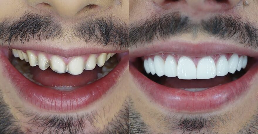 2-lente-de-contato-dental